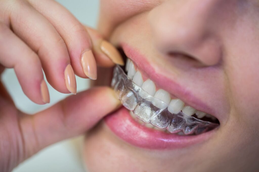 Persona colocándose un alineador dental transparente en los dientes.